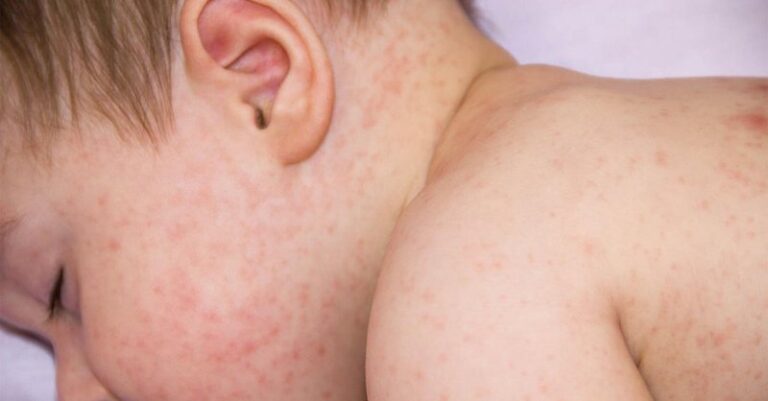 Bệnh Rubella là gì, triệu chứng và cách điều trị như thế nào
