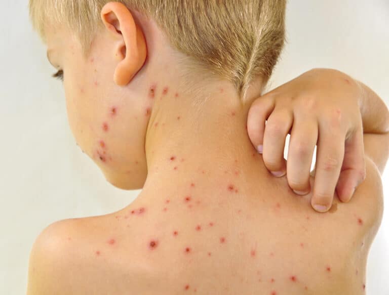 Nguyên nhân cách phòng chống bệnh thủy đậu ở trẻ em
